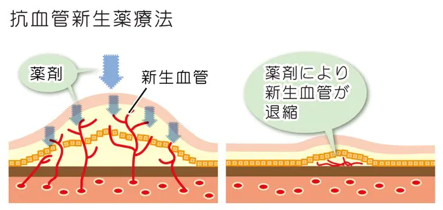 加齢黄斑（抗血管新生薬療法）